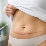 Abdominoplastia deixa cicatriz grande?