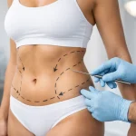 Melhores indicações para lipoaspiração localizada