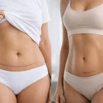 Abdominoplastia ou mini abdominoplastia?