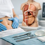 Guia da reconstrução da parede abdominal