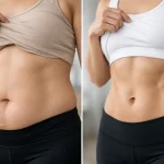 Antes e depois de diástase abdominal: o que muda