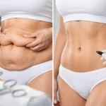 Quando indicar dermolipectomia abdominal?