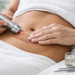 Tratamento para cicatriz hipertrófica cirúrgica