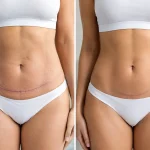Abdominoplastia versus miniabdominoplastia: diferenças