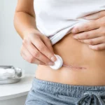 Como higienizar cicatriz de cirurgia com segurança
